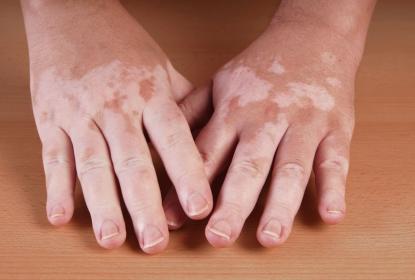 Celebran Día Mundial del Vitiligo: lo padece 2  por ciento  de la población mundial